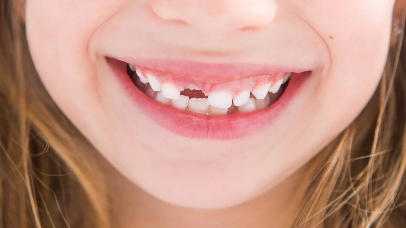 When Do Kids Start Losing Teeth?