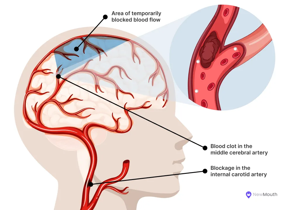 Transient ischemic attack