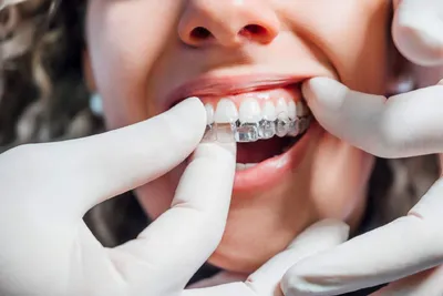 Does Invisalign Treatment Hurt?