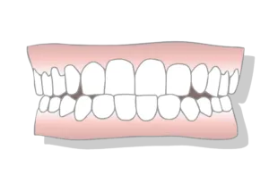 Underbite malocclusion scaled 1
