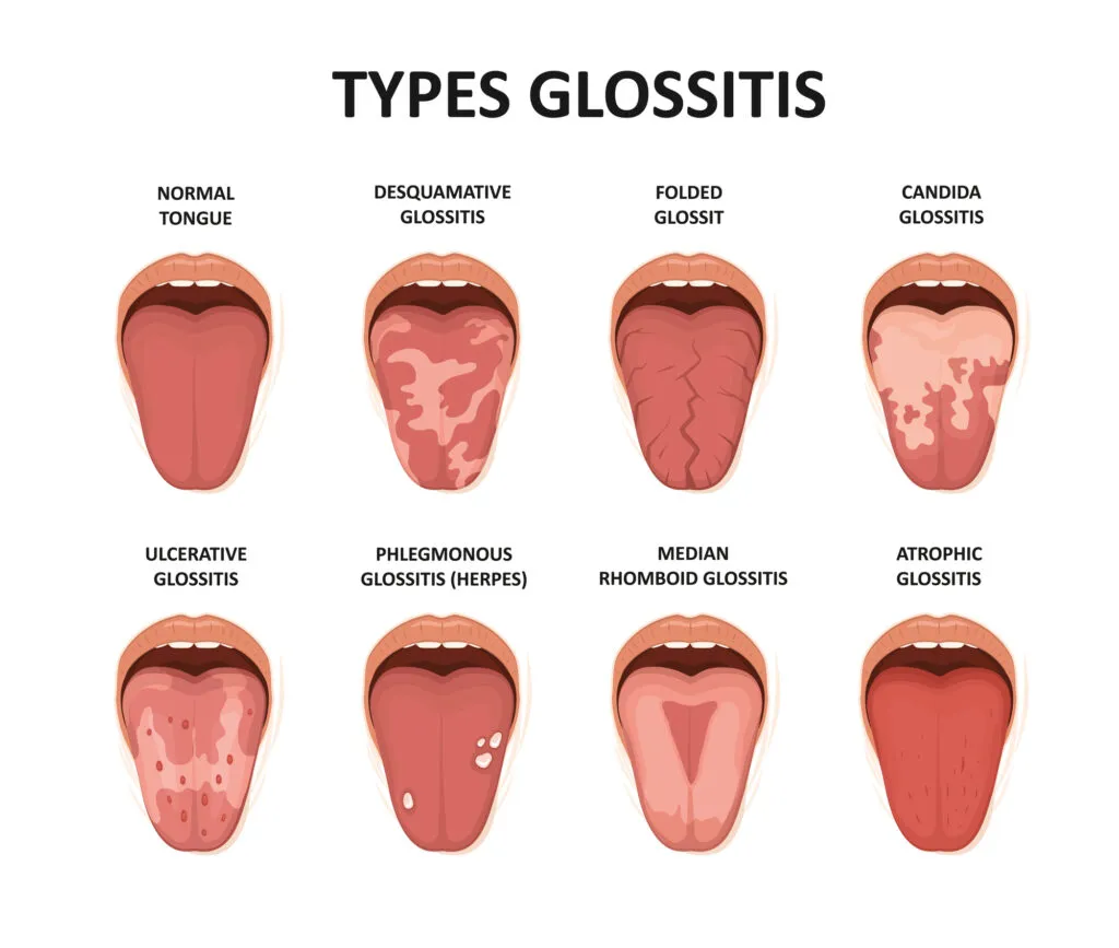 Vector image of Types glossitis. Tongue disease illustration