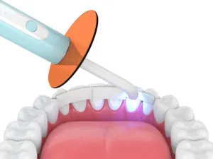 What is dental bonding NewMouth