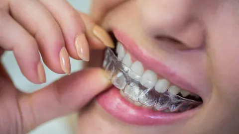 Can Invisalign Fix an Excessive Overbite?