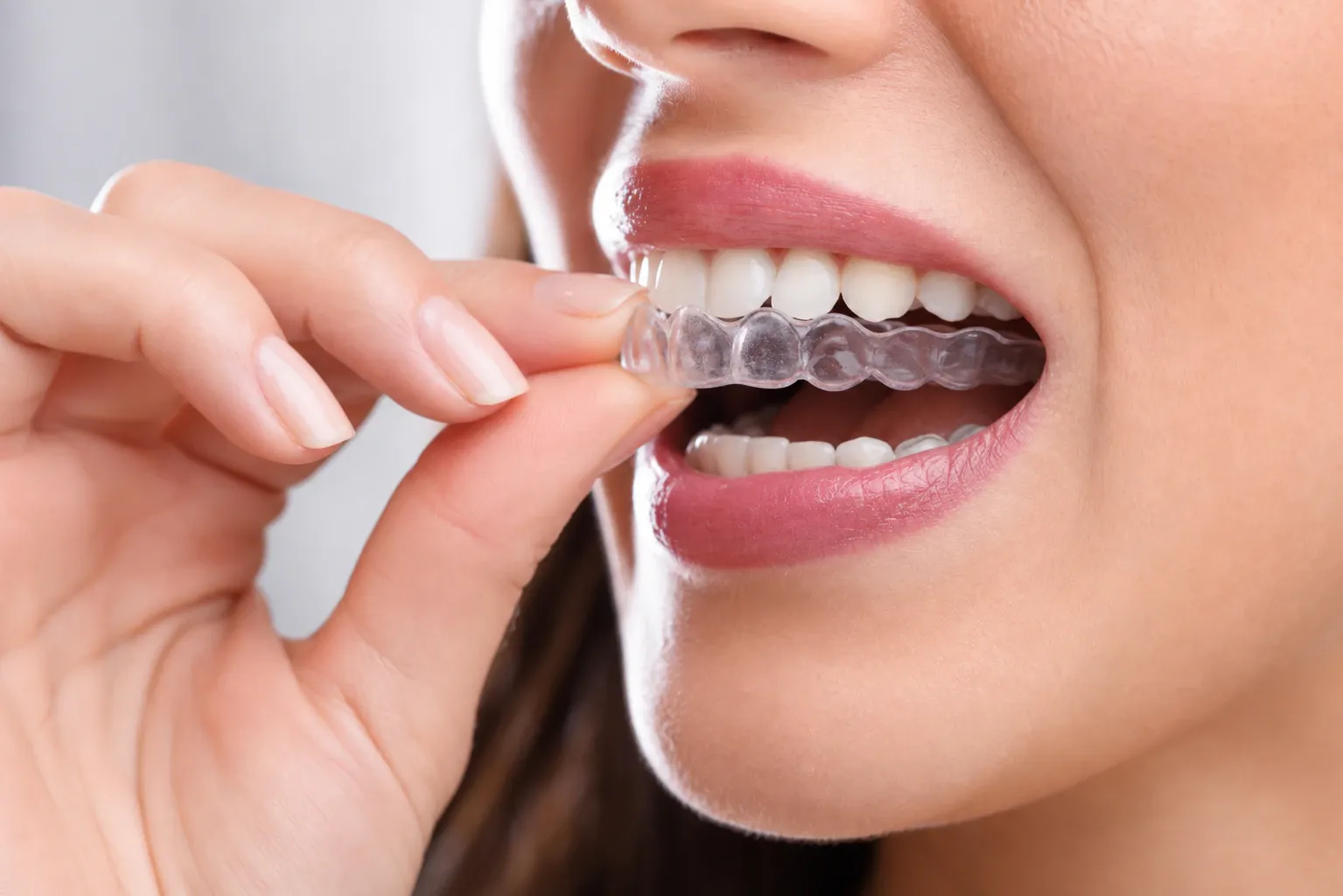 Woman inserting clear aligner nm 0695