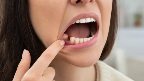 Can You Get Invisalign With a Missing Tooth?