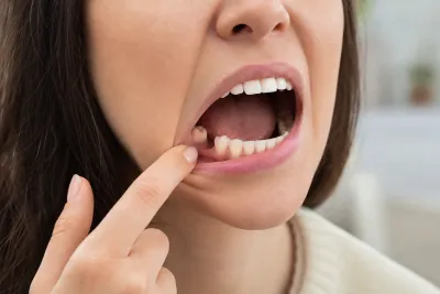 Can You Get Invisalign With a Missing Tooth?