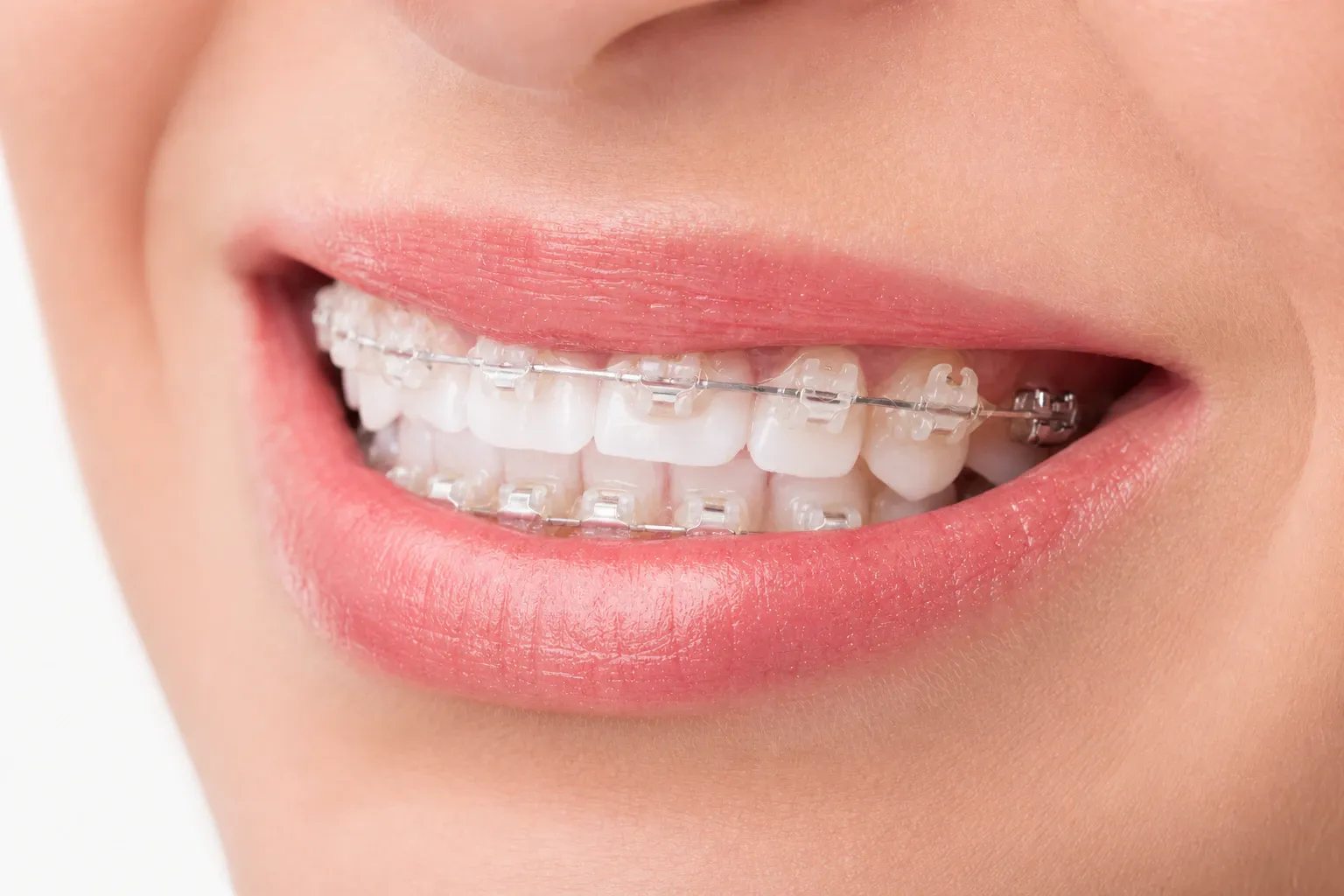 Woman smiling with braces nm 1146