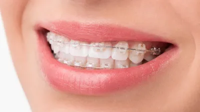 How to Whiten Teeth With Braces