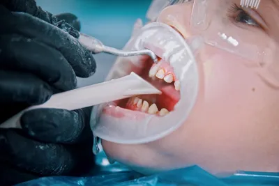 Baby Tooth Extractions: Causes, Procedure Steps & Aftercare
