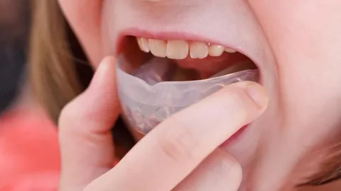 Underbite Correction for Children, Teens & Adults