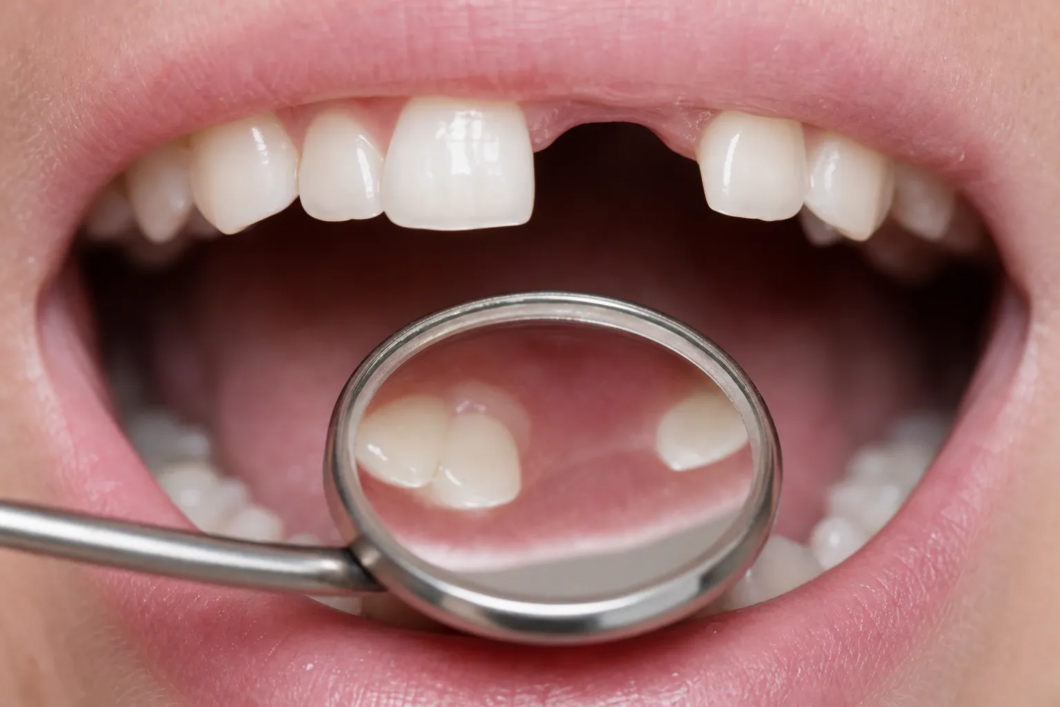 Young patient with small missing teeth examined by dentist nm 1370
