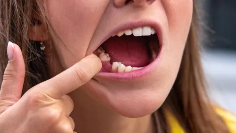Can You Get Invisalign With a Missing Tooth?