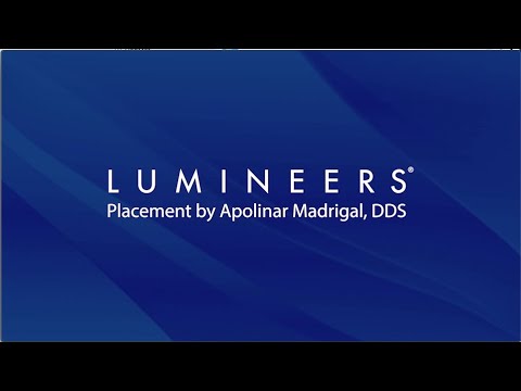 Time-Lapse Lumineers Placement by Apolinar Madrigal DDS | denmat.com | DenMat Dental Education