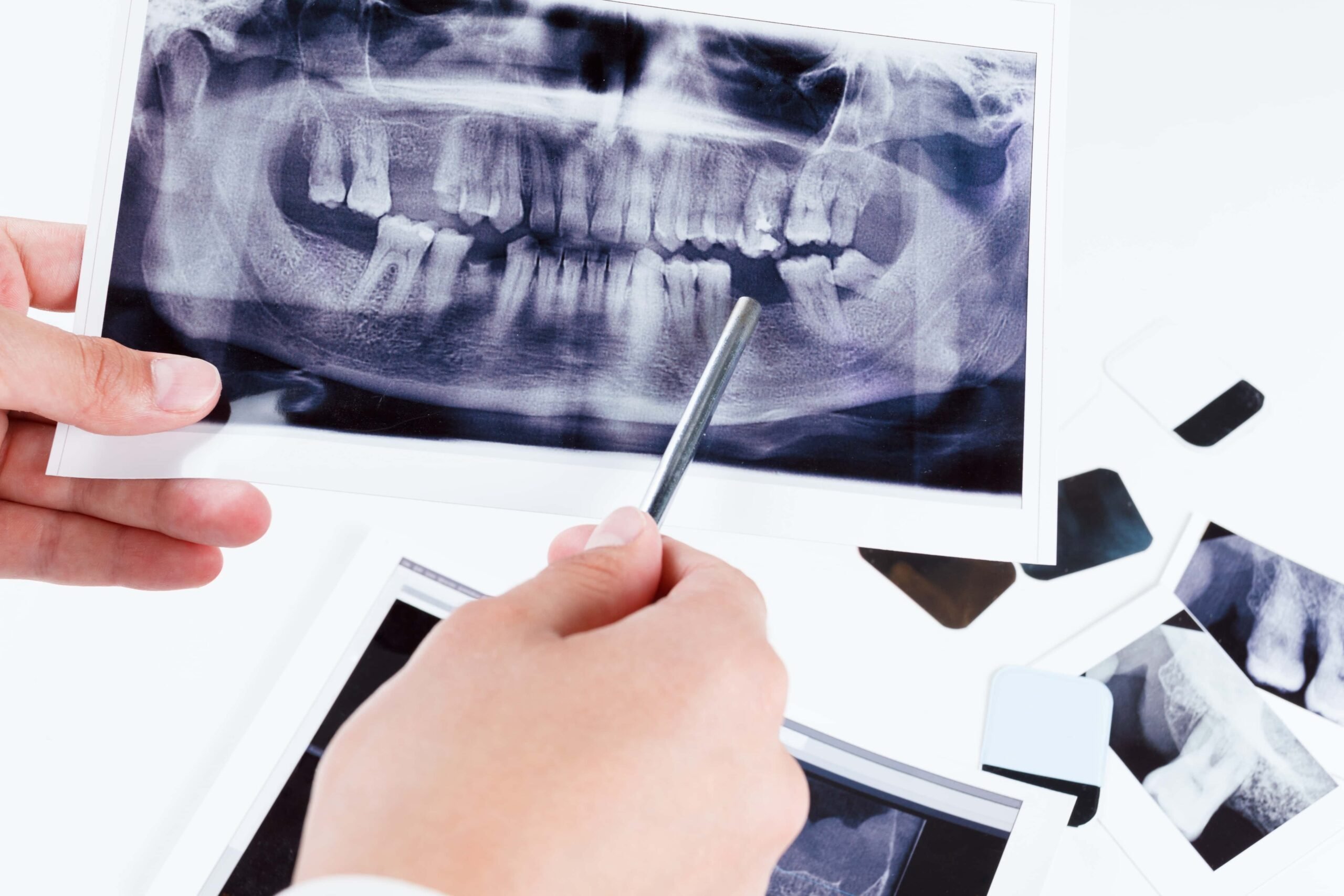 A hand holding and pointing to a dental X-ray image with a metal pointer while other dental X-ray images and items are placed on the table.