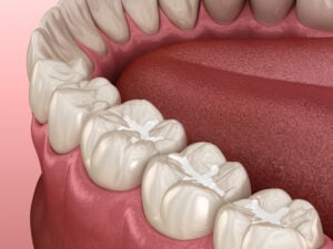Close-up illustration of a human mouth showing molars with dental sealants applied to the chewing surfaces.