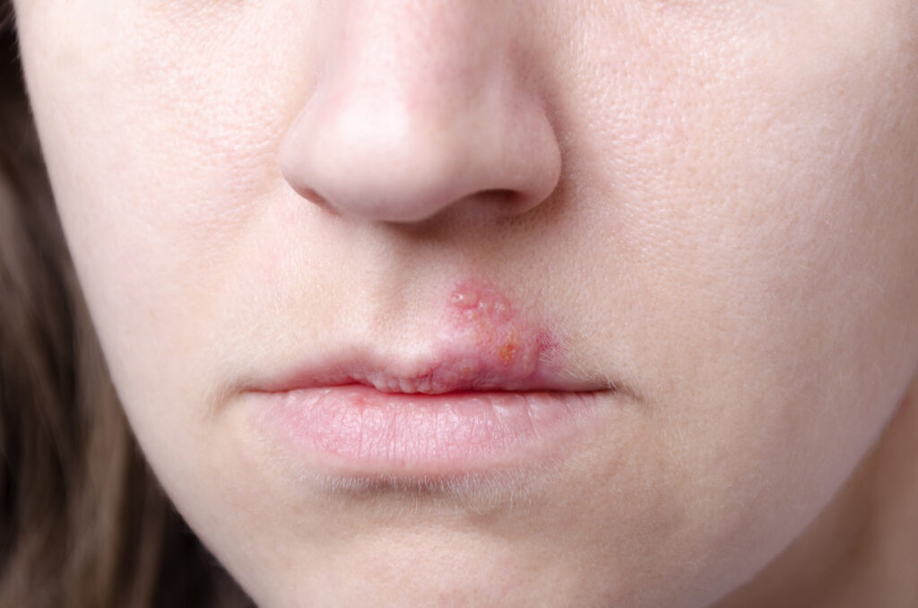 Close-up of a person's lips with a cold sore visible on the upper lip.